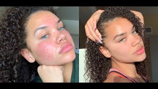 HOW I CLEARED MY SKIN IN A WEEK  SKINCARE  TIPS [upl. by Enyr825]