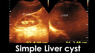 Simple Liver cyst  Enlarge prostate  Practical case [upl. by Soutor]