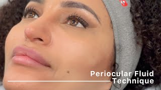 Periocular Fluid Technique complete protocol by Dr Siquier amp Dr Taskesen [upl. by Ecile575]