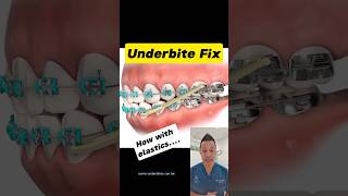 Elastics to Fix Your Underbite Heres How dentallan dentist shorts [upl. by Kcirdneh]