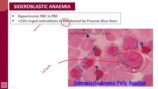 Hematology  1  U8L4  Sideroblastic anaemia [upl. by Joycelin]