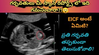 Echogenic Intracardiac Focus in telugu  fetal echo scan  pregnancy  Mom Geethas Tips [upl. by Eugilegna14]