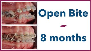 Orthodontic Open Bite Tip 🎢rollercoaster effect to your advantage [upl. by Catherin]