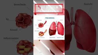 Lung sound in Pneumonia [upl. by Nired]