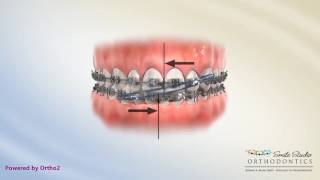 Elastics  Anterior Cross  Orthodontic Treatment  Orthodontic Treatment [upl. by Gascony]