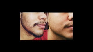 Minoxidil Beard 2 Months Transformation No Genetic [upl. by Ailahk]