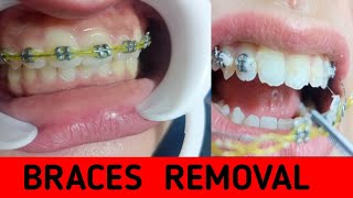 Dental braces removal and retainer on the same day [upl. by Akins]