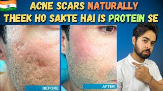 Remove Acne Scars Naturally  3 Remedies 100 Works With Results [upl. by Adnylg]