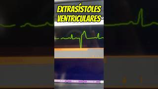 Mis extrasístoles ventriculares son de riesgo⁉️🤔⚠️ emergency cardiology [upl. by Eiknarf]