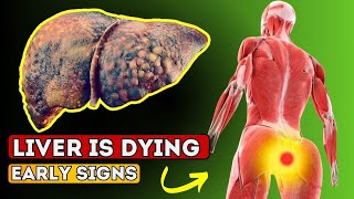 LIVER is DYING 12 Weird Signs of LIVER DAMAGE [upl. by Lenard771]