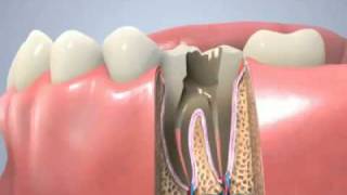 Traitement de canal traitement endodontique [upl. by Arturo]