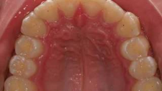 invisalign severe overjet [upl. by Melborn]