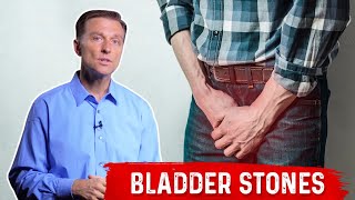 Bladder Stones Causes Symptoms amp Remedies  Dr Berg [upl. by Darej]