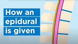 How an epidural is given  Bupa Health [upl. by Terej]