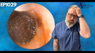 INSANE DEEP EAR WAX PLUG REMOVAL  EP1029 [upl. by Mariande755]