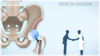 Pourquoi la pose de la prothèse estelle envisagée   Arthrolink [upl. by Raji]