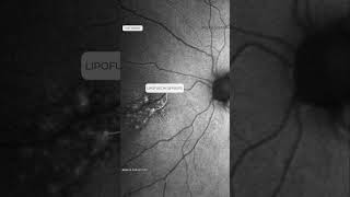 Multimodal analysis in a case of Choroidal Metastases from lung cancer Visit wwwretinographyorg [upl. by Aneem313]