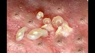 Shocking Cystic Blackheads amp Whiteheads Extraction Revealed  new blackheads this week 12301 [upl. by Jaimie]