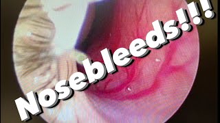 Nosebleeds epistaxis causes prevention treatments and more [upl. by Akimat]