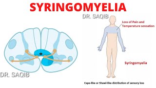 Syringomyelia [upl. by Lecia768]