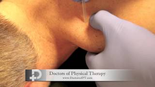 Trigger Point Dry Needling Local Twitch Response [upl. by Esinek]