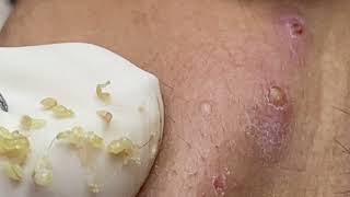 Acne treatment for Spa Linh Mun 2024 04 [upl. by Korney]