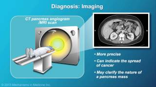 Pancreatic Cancer Pathophysiology Diagnosis and Staging [upl. by Suivat]