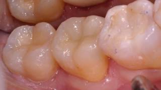 CEREC Dental Crowns by Ellicott City Dentist [upl. by Lem]