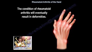 Rheumatoid Arthritis Of The Hand  Everything You Need To Know  Dr Nabil Ebraheim [upl. by Liggett284]