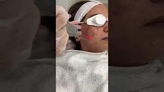 Treating Pigmentation using Carbon Peel  Laser Toning Treatment Video  Dr Rajdeep Mysore [upl. by Atews]