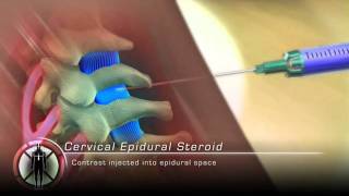 Cervical Epidural Steroid Injection Procedure Animation [upl. by Shiller672]