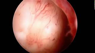 Focal Complex Atypical Endometrial Hyperplasia amp Submucosal Myoma [upl. by Bernadette937]