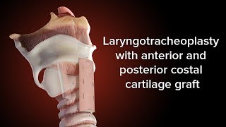 Medical Animation Anterior and Posterior Cricoid Split  Cincinnati Childrens [upl. by Yelahc]