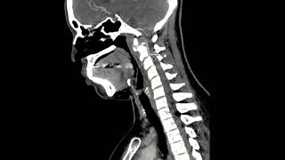 Calcifications of the longus colli [upl. by Derr]