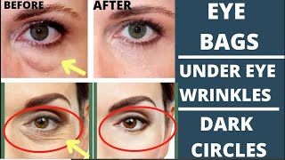 🛑 ANTIAGING FACE EXERCISES FOR EYE BAGS EYE WRINKLES DARK CIRCLES amp TIGHTEN DROOPY EYELIDS [upl. by Neelyak]