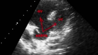 TETRALOGY OF FALLOT TOF  ECHOCARDIOGRAPHY SERIES BY DR ANKUR K CHAUDHARI [upl. by Ejrog683]