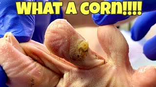 EXTREMELY SATISFYING CORN REMOVAL FROM FEET [upl. by Notgnirra658]