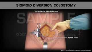 Sigmoid Diversion Colostomy [upl. by Tempa312]