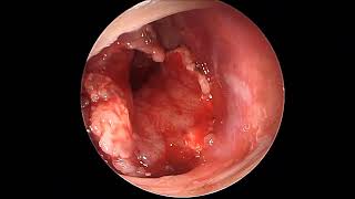 Right sided endoscopic endonasal benign tumour excision [upl. by Tannen]