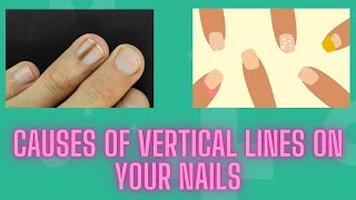 Causes Of Vertical Lines On Your Nails and What to Do About It  Nuse Healthy [upl. by Evangeline]