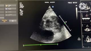 Aortic Root Abscess Bicuspid Aortic Valve Infective Endocarditis [upl. by Judith]