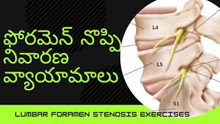 Foramen stenosis L4L5L5S1 Foraminal stenosis Lumbar Foramen treatment in Telugu [upl. by Kelsey]