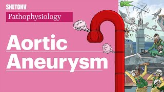 Aortic Aneurysms Pathophysiology amp Risk Factors Part 1  Sketchy Medical  USMLE Step 1 [upl. by Aivirt634]