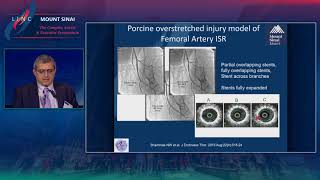 Atherectomy for Restenosis Future of Combination Therapy [upl. by Alokin]