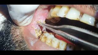 Leukoplakia buccal mucosa  Cautery  Laser  Dr Hitesh Patel [upl. by Rania77]