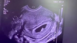 7 Weeks Ultrasound  Checking for a Heartbeat [upl. by Oakes]