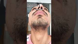 1 Month Minoxidil Journey beard beardeddragon [upl. by Roti938]