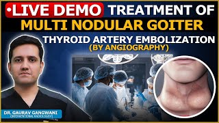 Non Surgical Treatment Of Multi Nodular Goiter  Thyroid Artery Embolization  Dr Gaurav Gangwani [upl. by Trinette]