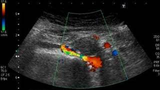 retroaortic left renal vein [upl. by Ahsinned366]