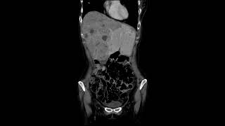 meta liver dt breast cancer [upl. by Lud]